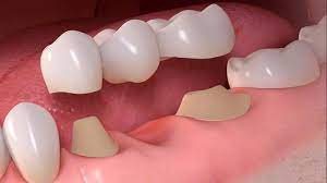 Pontefix Cemento provvisorio per corone dentali, fissare ponti e capsule  dentali, colla per denti, come incollare un ponte dentale, colla per denti  provvisori in farmacia